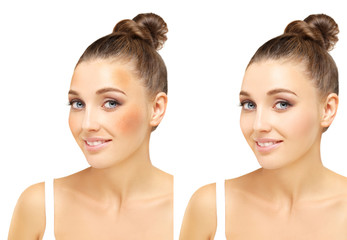 Dark spots, freckles,hyperpigmentation(melasma or chloasma).