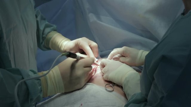 The surgeon cauterizes the blood vessels to stop the loss of blood
