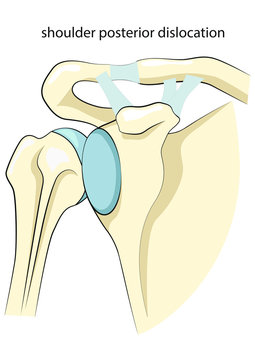 Shoulder posterior dislocation