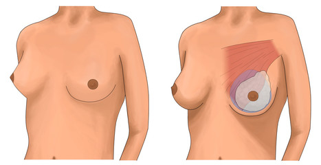 Breast augmentation