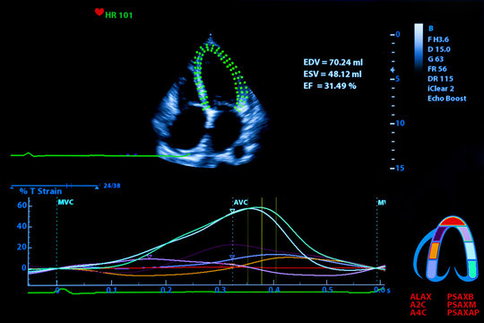 Colourful image of homan heart ultrasound monitor