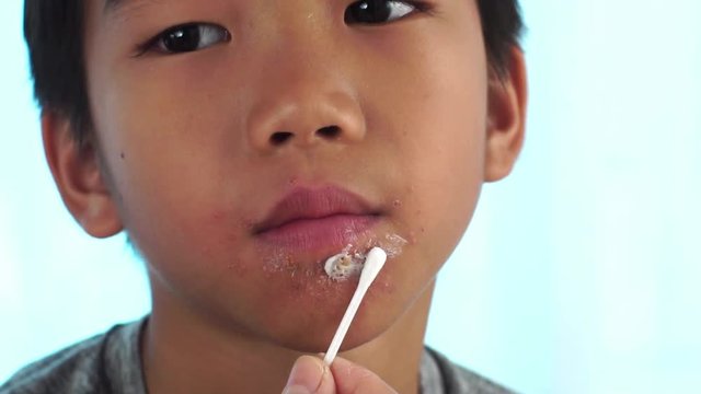 Close up of young Asian boy face skin affected by herpes and apply medical cream to cure.