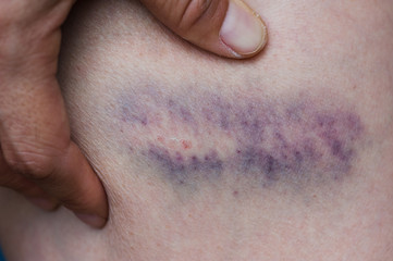 people with wounded leg holding in hands