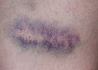 Fototapeta premium bruise injury on young woman thigh