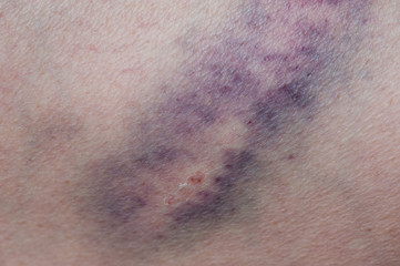 bruise injury on young woman knee