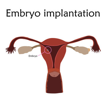 Embryo implantation. The fertilized egg, uterus, womb. Anatomy flat illustration. White background.