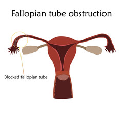 Fallopian tube obstruction. Human realistic uterus. Anatomy flat illustration with specification. Colored image, white background. Gynecological diseases.