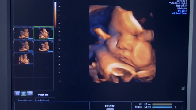 Close up of baby's face on an ultrasound monitor