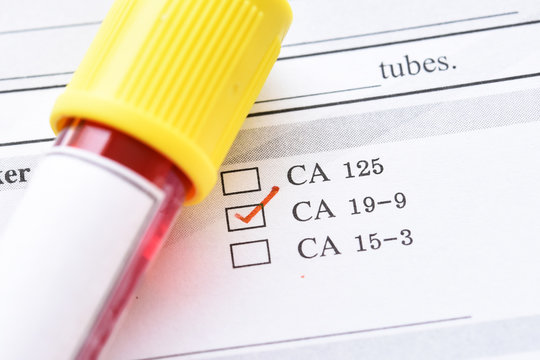 Blood sample for CA19-9 test, tumor marker for pancreatic cancer