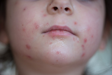 Chickenpox on the body of a little girl - obrazy, fototapety, plakaty