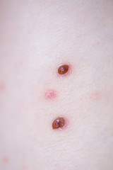 Chickenpox on the body of the little child