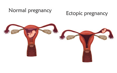 Ectopic and normal pregnancy. The fetus, uterus, womb. Anatomy flat illustration. White background.