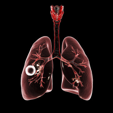 Fibrous-cavernous pulmonary tuberculosis, 3D illustration showing tuberculosis cavity in the lung