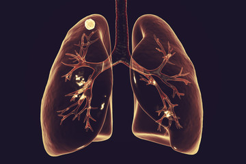 Secondary tuberculosis in lungs, apical nodule, 3D illustration