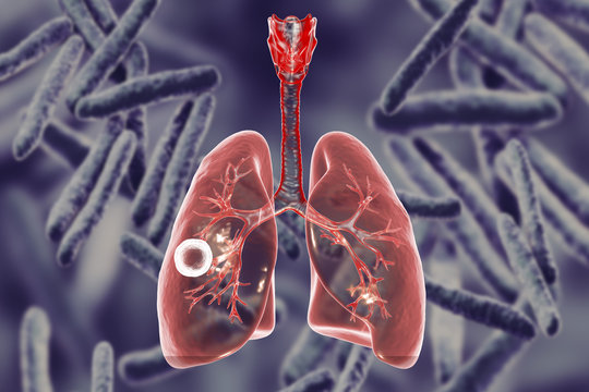 Fibrous-cavernous pulmonary tuberculosis, 3D illustration showing tuberculosis cavity in the lung