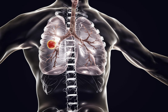 Fibrous-cavernous pulmonary tuberculosis, 3D illustration showing tuberculosis cavity in the lung