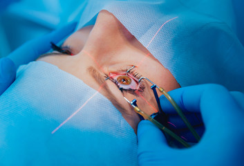 Laser vision correction. A patient and team of surgeons in the operating room during ophthalmic surgery. Eyelid speculum. Lasik treatment. - obrazy, fototapety, plakaty