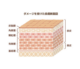 皮膚断面図 健康な皮膚とダメージを受けた皮膚の比較図 Wall Mural Barks