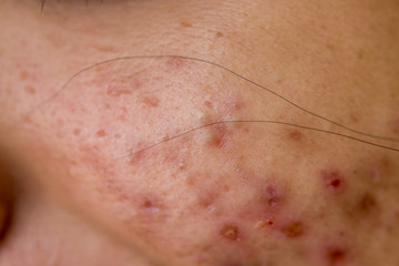Backgrounds of Scarring Caused by acne on the face.