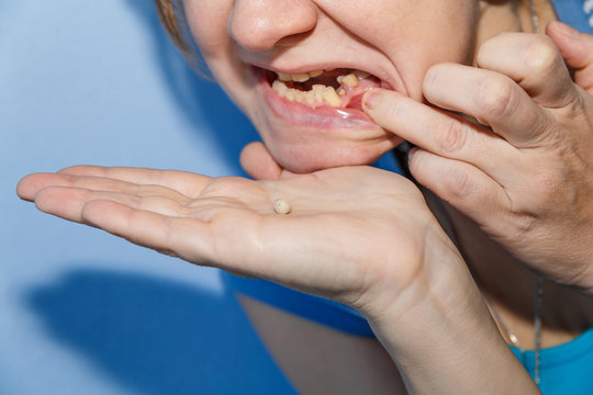 Women, showing mouth without tooth using fingers and dropped tooth crown