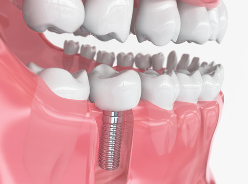 Tooth human implant 