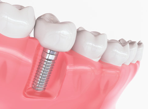 Tooth human implant 
