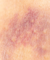 Fototapeta premium bruise on the skin