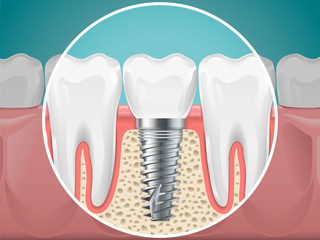 Stomatology illustrations. Dental implants and healthy teeth - obrazy, fototapety, plakaty