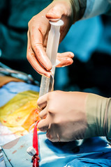 The surgeon pours saline into the ventricles during surgery to check the competence of the valves.