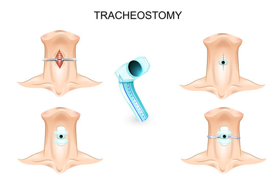 tracheostomy. tracheostomy tube