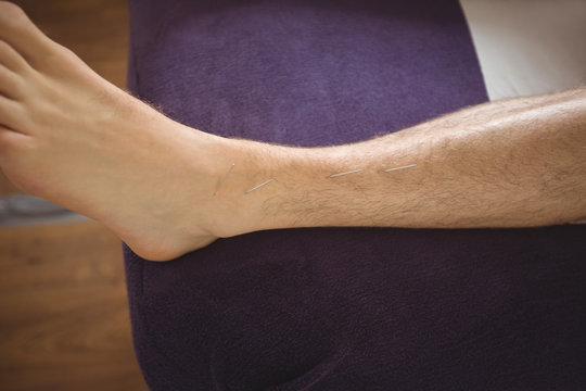 Patient getting dry needling on leg