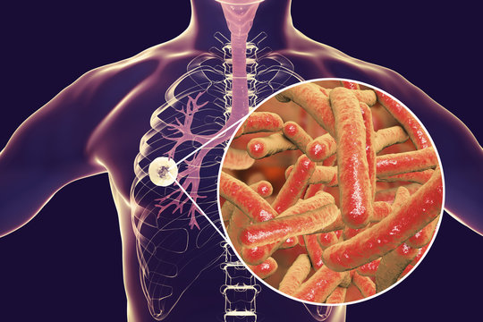 Fibrous-cavernous pulmonary tuberculosis and close-up view of Mycobacterium tuberculosis bacteria, 3D illustration showing cavity in the lung