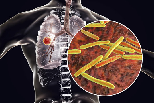Fibrous-cavernous pulmonary tuberculosis and close-up view of Mycobacterium tuberculosis bacteria, 3D illustration showing cavity in the lung