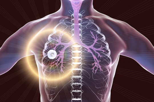 Fibrous-cavernous pulmonary tuberculosis, 3D illustration showing tuberculosis cavity in the lung