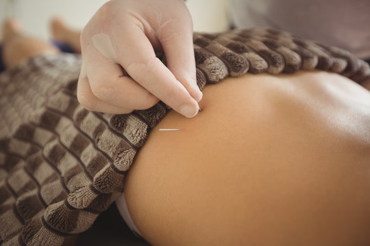 Close-up of physiotherapist performing dry needling on patient
