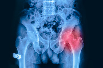 X-ray image of pelvis and hip from a human body part