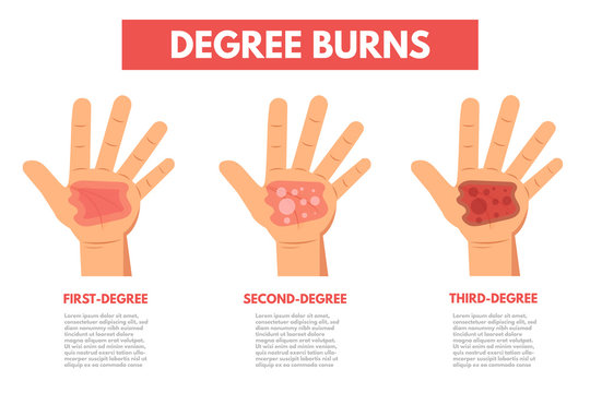 Degree burns of skin. Infographic Vector illustration.
