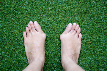 woman legs with bunions stand on green grass backgroud