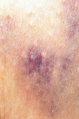 Fototapeta premium bruise on the skin
