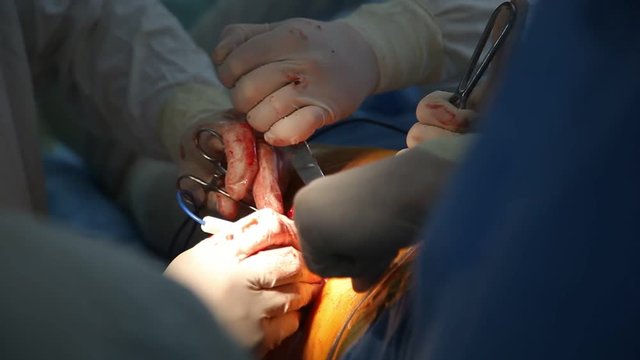 A striking closeup of orthopedic surgeons inserting electric instruments in a red hole to fire a coxal joint of a hapless patient in a room