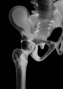 Human hip joint-Bone X ray film-Healthcare-Human Anatomy and Medical concept-Isolated on black background.
