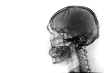 X-ray image of side view asian skull black and white