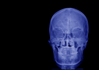 X-ray image of front view asian skull and blank area at left side