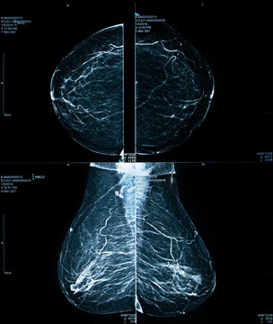 Mammogram / Mammography xray image for breast cancer prevention and diagnosis. Medical technology concept.