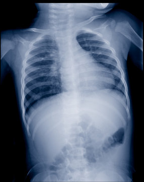 X-ray image of chest in child