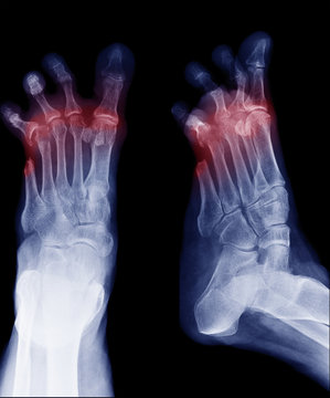 X-ray image of diabetic foot amputation, AP and oblique view, Radiography with deformed toes