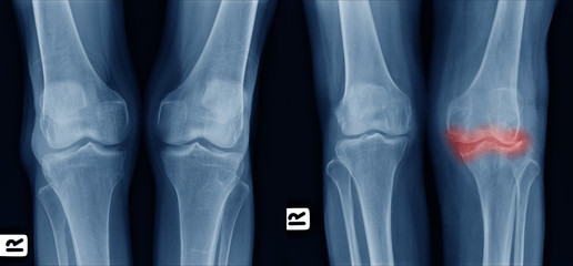 X-ray image show comparison of older normal knee on left side and osteoarthritis knee on right side front view. area of deformity with red color mark. - obrazy, fototapety, plakaty