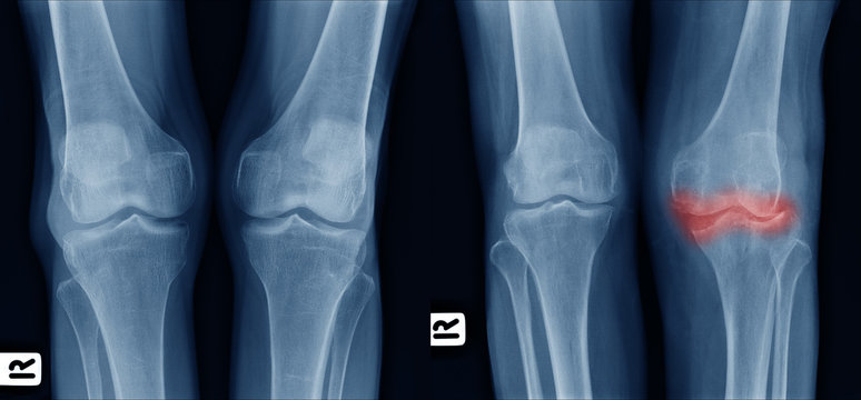 X-ray image show comparison of older normal knee on left side and osteoarthritis knee on right side front view. area of deformity with red color mark.