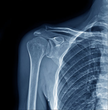X-ray of right human shoulder joint show humerus, scapular, clavicle, lips, lung and part of heart.