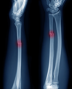 x-ray image show fracture of ulnar bone in arm at red area mark